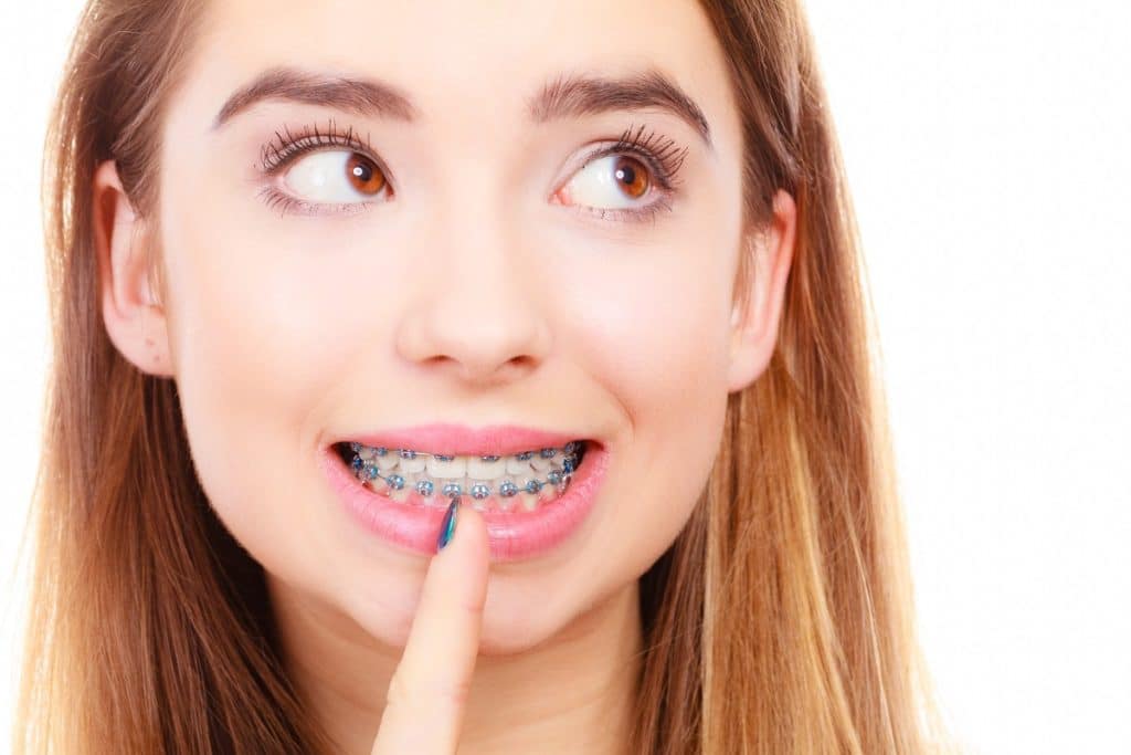 Average Cost Of Braces Princeton Orthodontics   Average Cost Of Braces 1024x683 