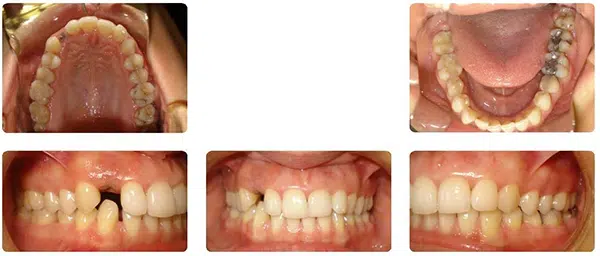 Invisalign in Princeton, TX