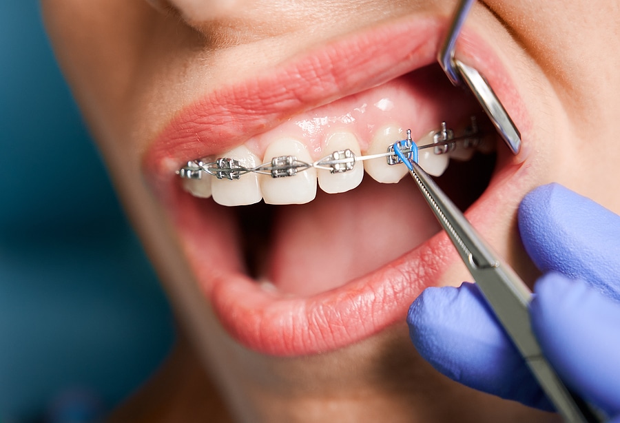 Is a Loose Bracket an Orthodontic Emergency