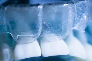 How Is Invisalign Different From Smile Direct Club?