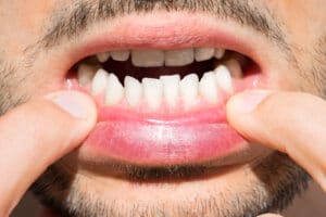 What can Invisalign fix? Crooked teeth