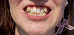 What Can Invisalign Fix? Crowded Teeth