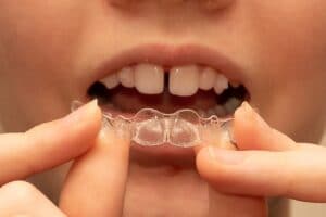 What can Invisalign fix? Gap Teeth