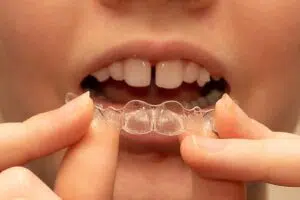 What Can Invisalign Fix? Gap Teeth