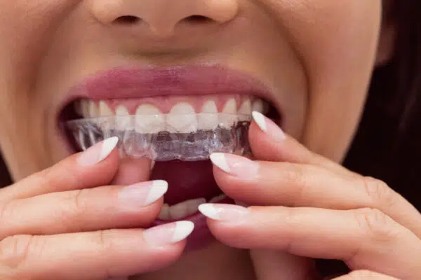 Invisalign Covered By Insurance