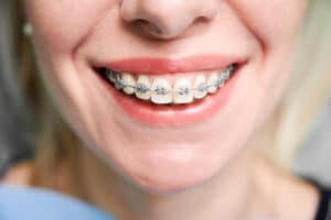 Does Getting Braces Hurt?
