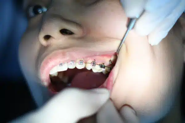 Does Getting Braces Hurt