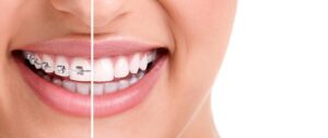 Dental Braces Explained: A Complete Guide for First-Time Wearers