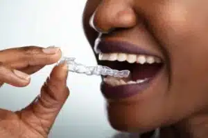 Living with Invisalign: A Guide to Daily Care and Routine