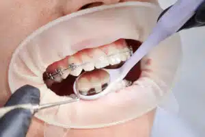 Manage Braces Discomfort: Expert Techniques for Relief